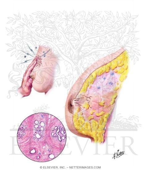 Watermarked preview of unlabeled image: Fibrocystic Disease: Early Changes