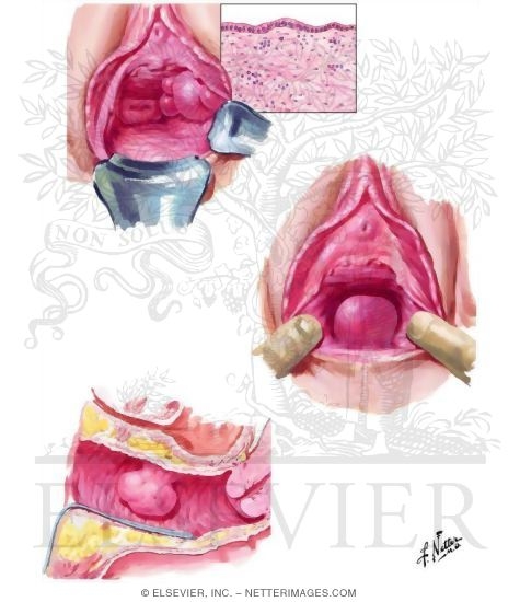 Watermarked preview of unlabeled image: Cysts and Primary Benign and Malignant Tumors