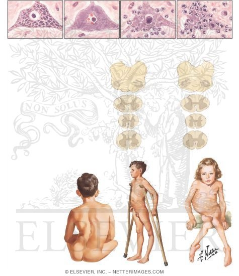 Watermarked preview of unlabeled image: Poliomyelitis