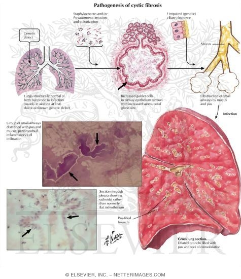 Watermarked preview of labeled image: Pathogenesis of Cystic Fibrosis