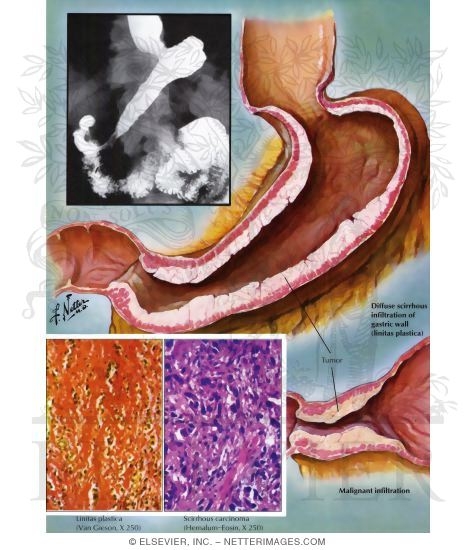 Watermarked preview of labeled image: Carcinomas of the Stomach