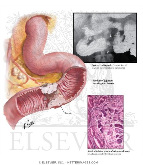 Watermarked preview of labeled image: Cancer of the Small Intestine: Adenocarcinomas