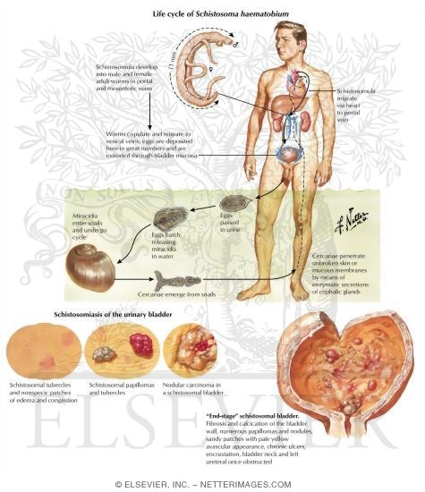Urinary Schistosomiasis