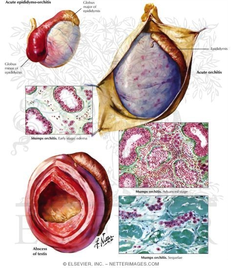 Watermarked preview of labeled image: Infection and Abscess of the Testis and the Epididymis