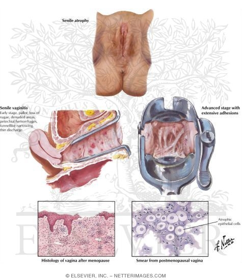 Vaginal Atrophy