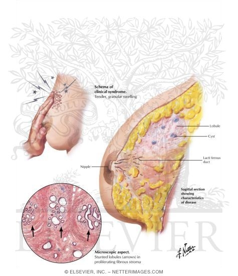 Watermarked preview of labeled image: Fibrocystic Disease: Early Changes