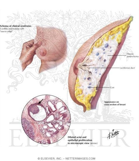 Fibrocystic Disese: Adenosis