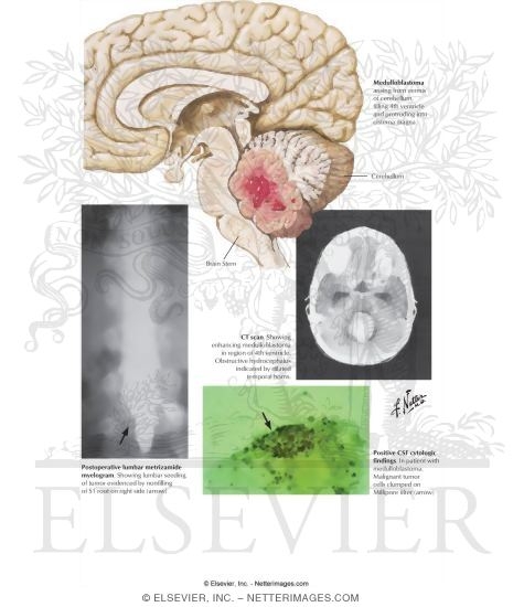 Watermarked preview of labeled image: Brain Tumors In Children