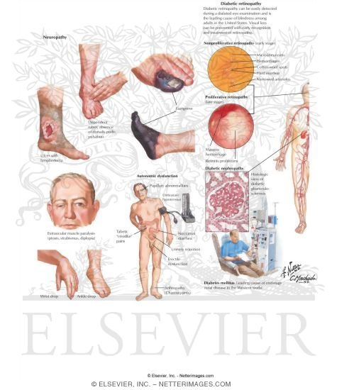 Non - Insulin - Dependent Diabetes Mellitus