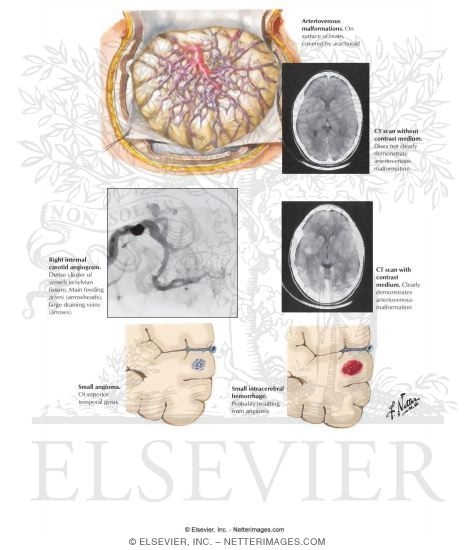 Watermarked preview of labeled image: Vascular Malformations