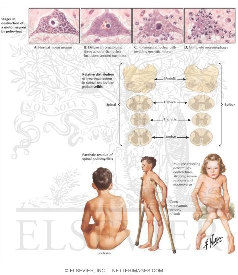 Poliomyelitis