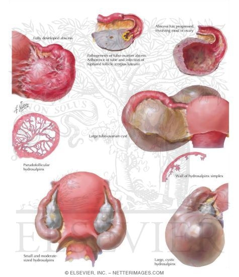 Watermarked preview of labeled image: Hydrosalpinx (Chronic Pelvic Inflammatory Disease)