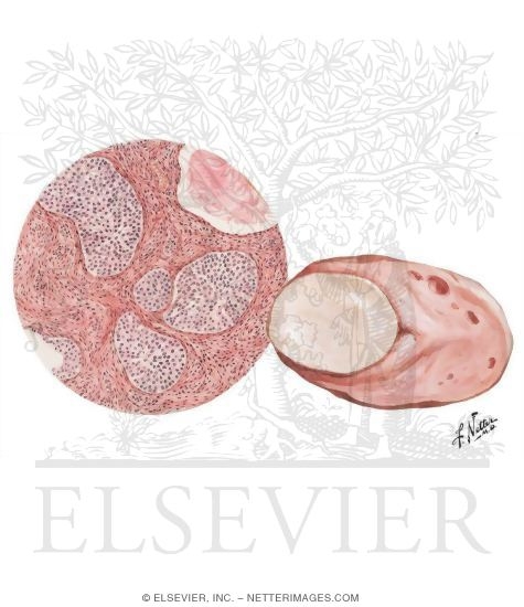 Transitional Cell (Brenner) Tumor