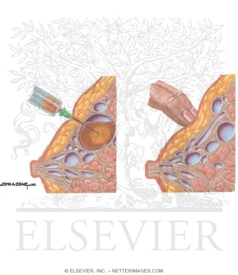 breast cyst asperation Tranny boty tube