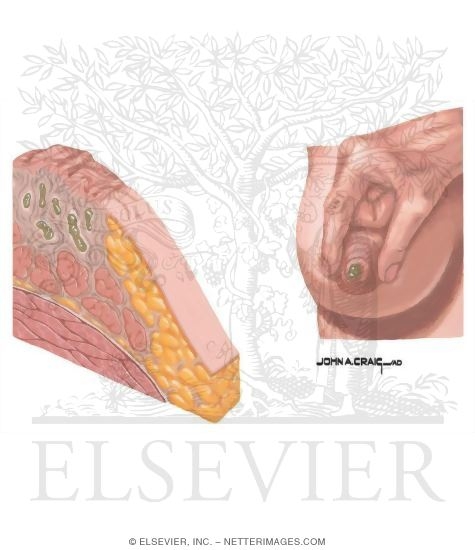 Breast: Duct Ectasia
Mammary Duct Ectasia