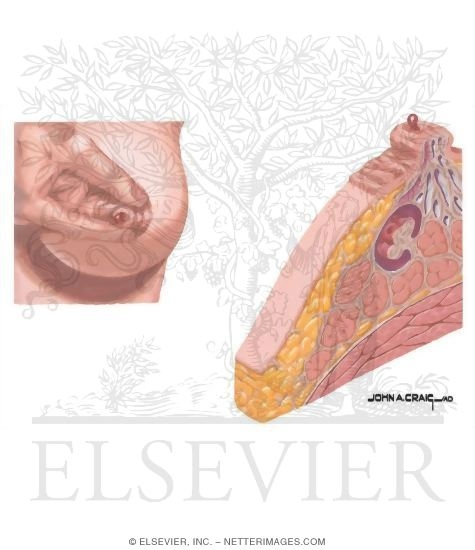 Breast: Intraductal Papilloma
Solitary Intraductal Papilloma
