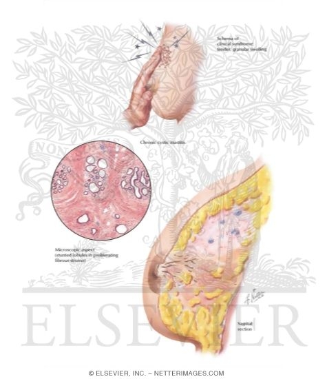 Breast: Pain (Mastodynia, Mastalgia)