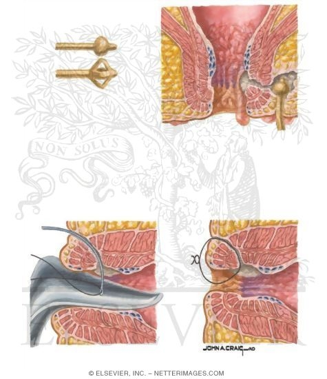 Anorectal Fistula
Appearance and Management of Anorectal Crohn's Disese