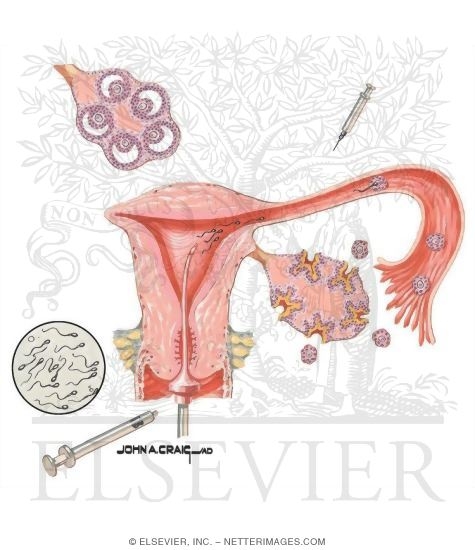 Watermarked preview of unlabeled image: Assisted Reproduction