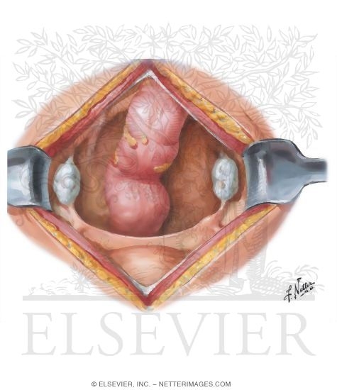 Watermarked preview of unlabeled image: Uterine Anomalies: Uterine Agenesis