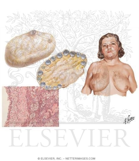 Watermarked preview of unlabeled image: Polycystic Ovarian Disease