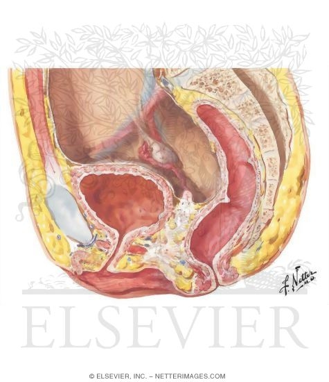 Watermarked preview of unlabeled image: Vaginal Agenesis