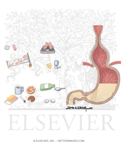Gastroesophageal Reflux