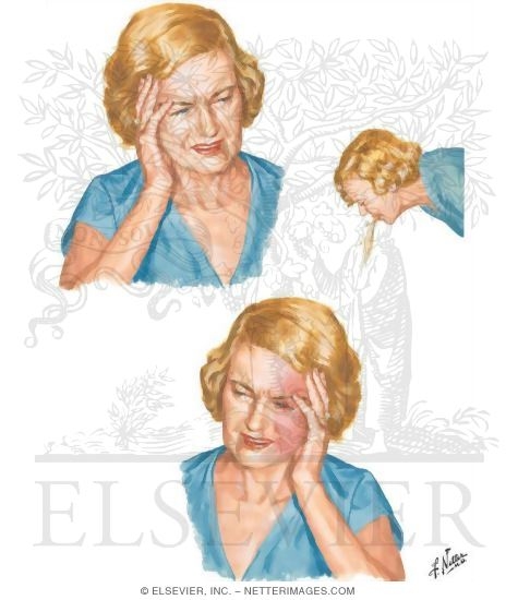 Headache: Tension, Cluster and Migraine