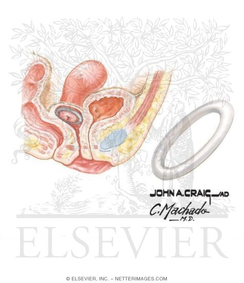 Watermarked preview of unlabeled image: Pessary Therapy