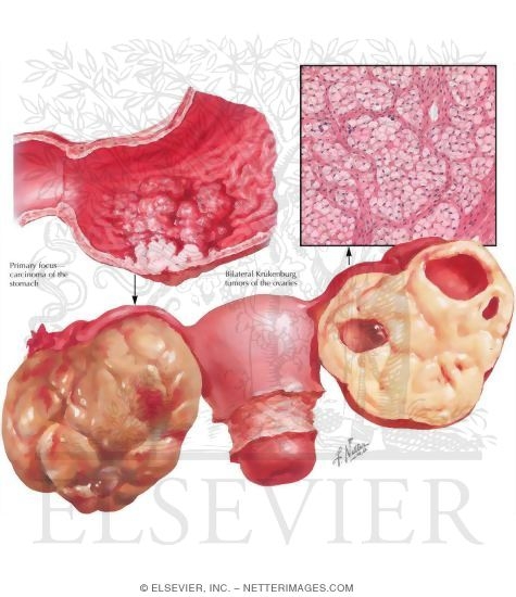 Watermarked preview of labeled image: Krukenberg Tumor