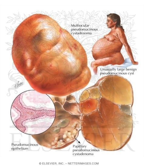 Watermarked preview of labeled image: Mucinous Ovarian Cysts