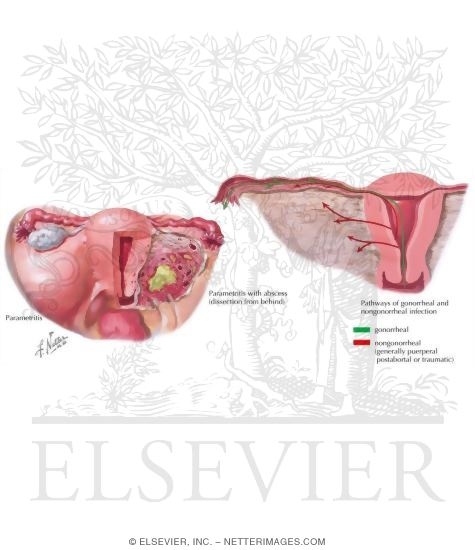 Watermarked preview of labeled image: Pelvic Inflammatory Disease (PID)