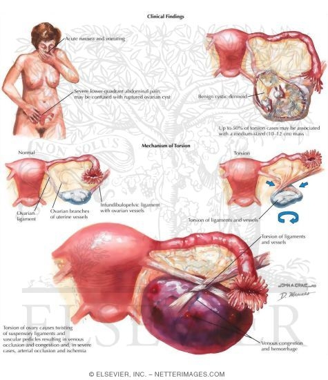 Watermarked preview of labeled image: Ovarian Torsion