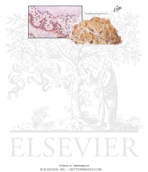 Watermarked preview of labeled image: Pseudomyxoma Peitonei
