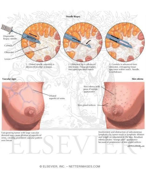 Watermarked preview of labeled image: Breast: Cancer