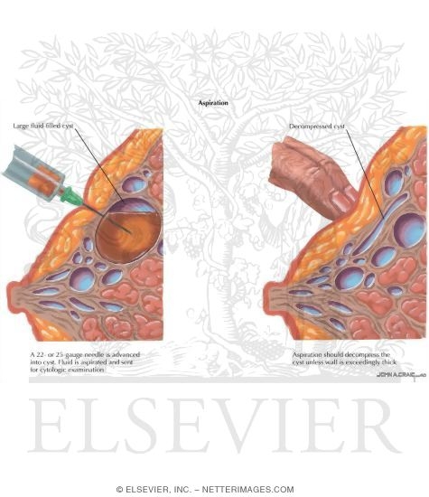 painful cysts in breast Painful cysts in breast