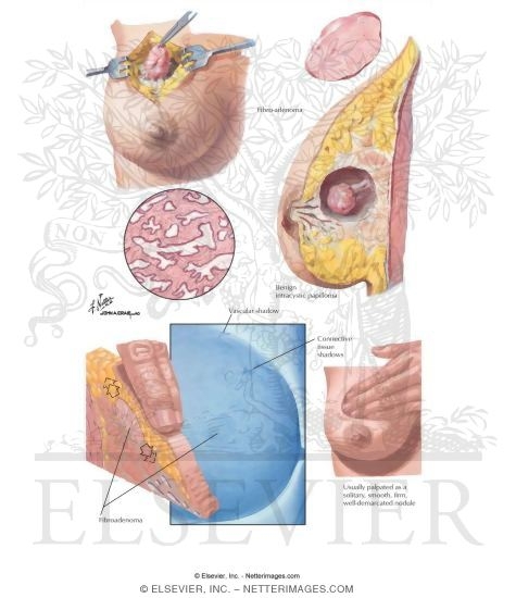 Watermarked preview of labeled image: Breast: Fibroadenoma