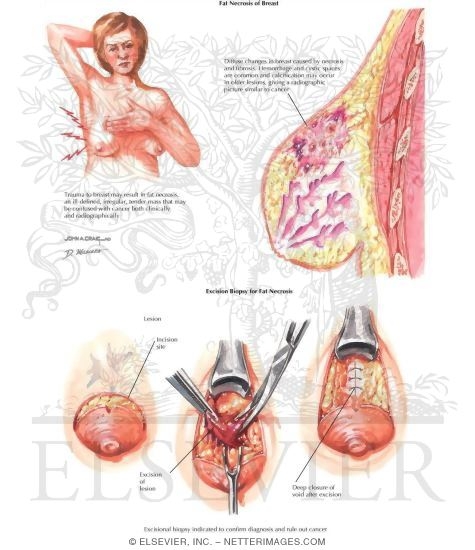 Fat Necrosis of Breast
Breast: Fat Necrosis
Breast: Fat Necrosis/Fat Necrosis of Breast