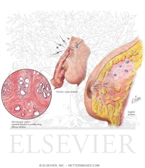 Breast: Pain (Mastodynia, Mastalgia)