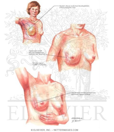 Image result for mondor disease breast