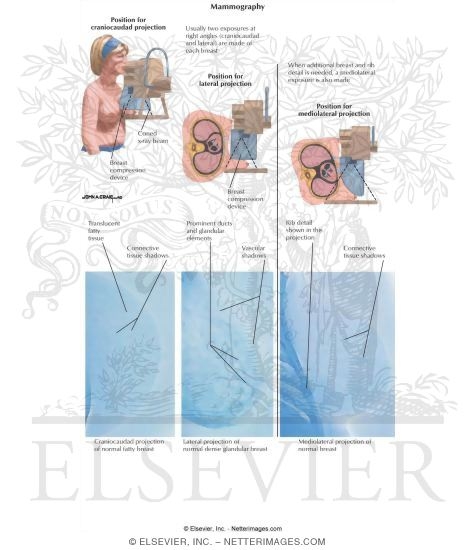 Watermarked preview of labeled image: Mammography