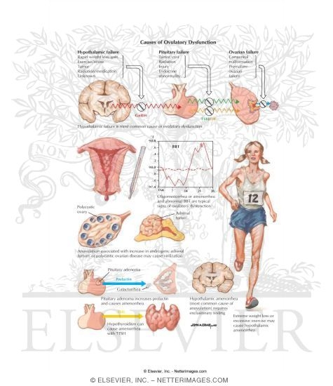 Watermarked preview of labeled image: Causes of Ovulatory Dysfunction