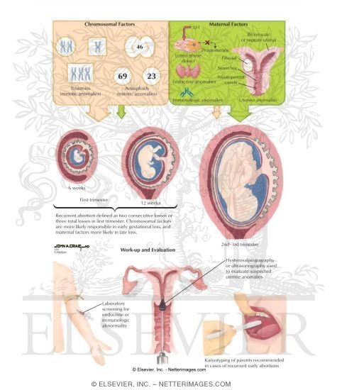 Watermarked preview of labeled image: Recurrent Abortion
Abortion: Recurrent