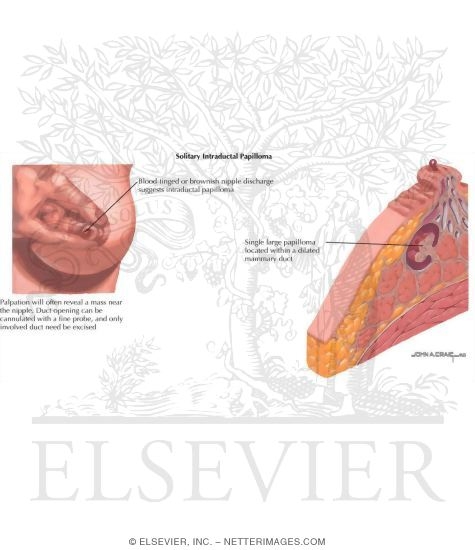 Breast: Intraductal Papilloma
Solitary Intraductal Papilloma