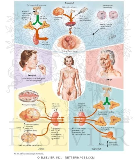 Watermarked preview of labeled image: Hirsutism and Virilization