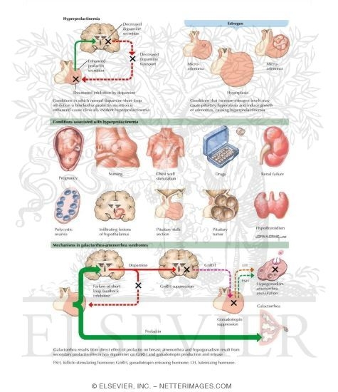 Watermarked preview of labeled image: Hyperprolactinemia