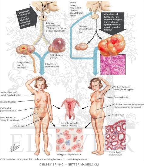 Precocious Puberty (Continued)
