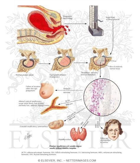 Postpartum Pituitary Necrosis