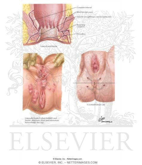Watermarked preview of labeled image: Anorectal Fistula