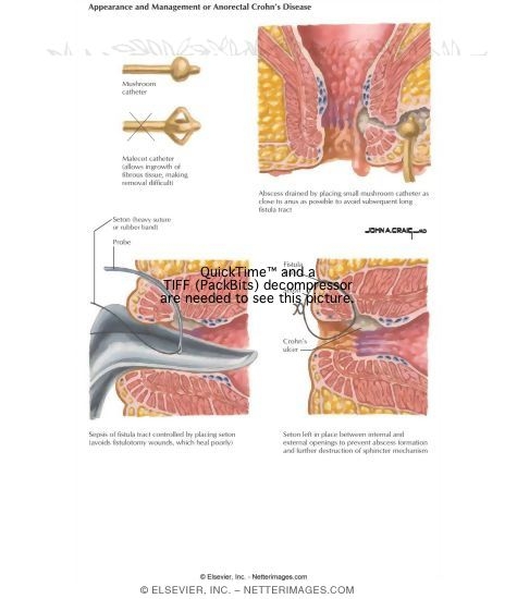 Watermarked preview of labeled image: Anorectal Fistula
Appearance and Management of Anorectal Crohn's Disese